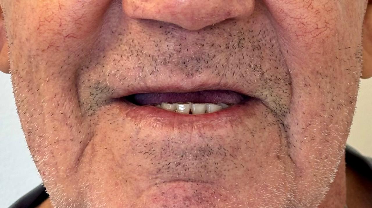 Reabilitação com Prótese — antes