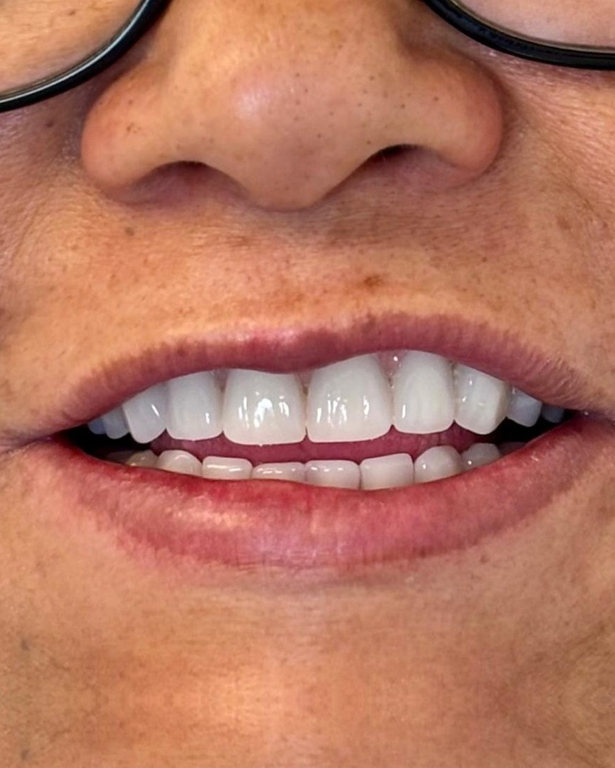 Implante Dental — depois