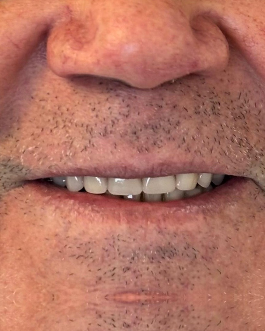 Reabilitação com prótese — depois