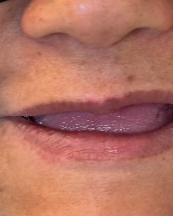 Implante Dental — antes