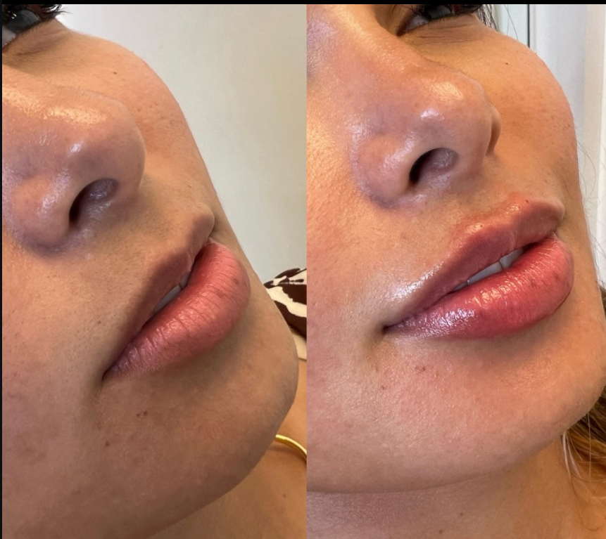 Antes e depois de preenchimento labial — paciente da Dra. Kalindi